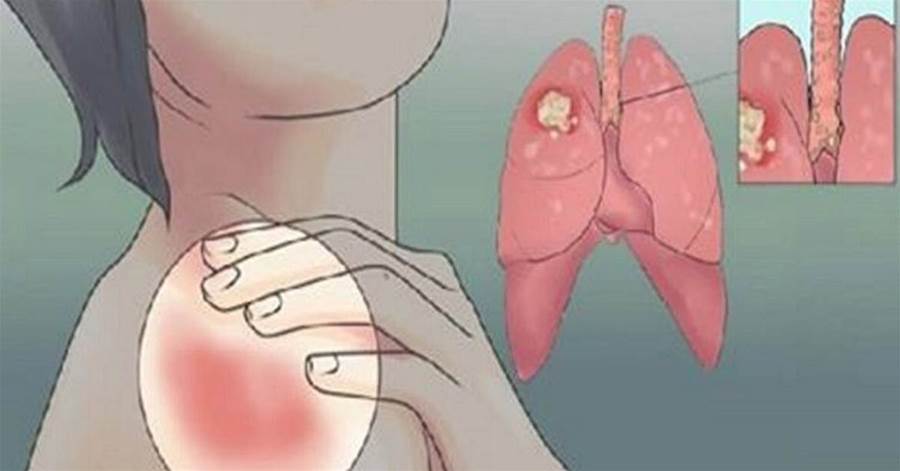 10 sintomas que podem ser sinal de câncer de pulmão e você não sabia