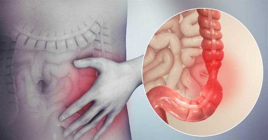 6 tipos de dor no intestino que não devem ser ignoradas; algumas delas podem ser sinal de câncer